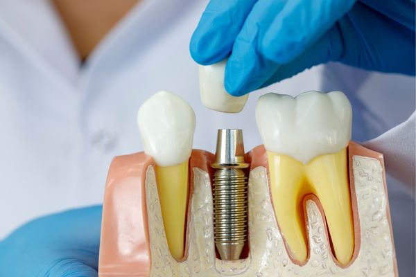 implantes dentales getafe