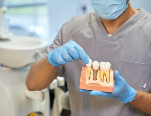 Implantes Dentales Duraderos: Factores que Aseguran una Larga Duración