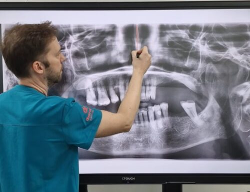 ¿Cuándo es necesario regenerar hueso antes de colocar un implante dental? La visión del Dr. David Valero en Getafe